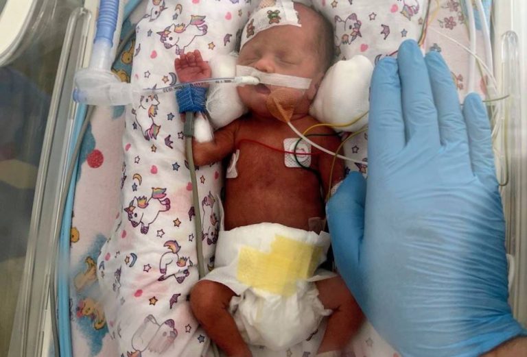 У львівській лікарні нейрохірурги вперше оперували мозок 750-грамового немовляти