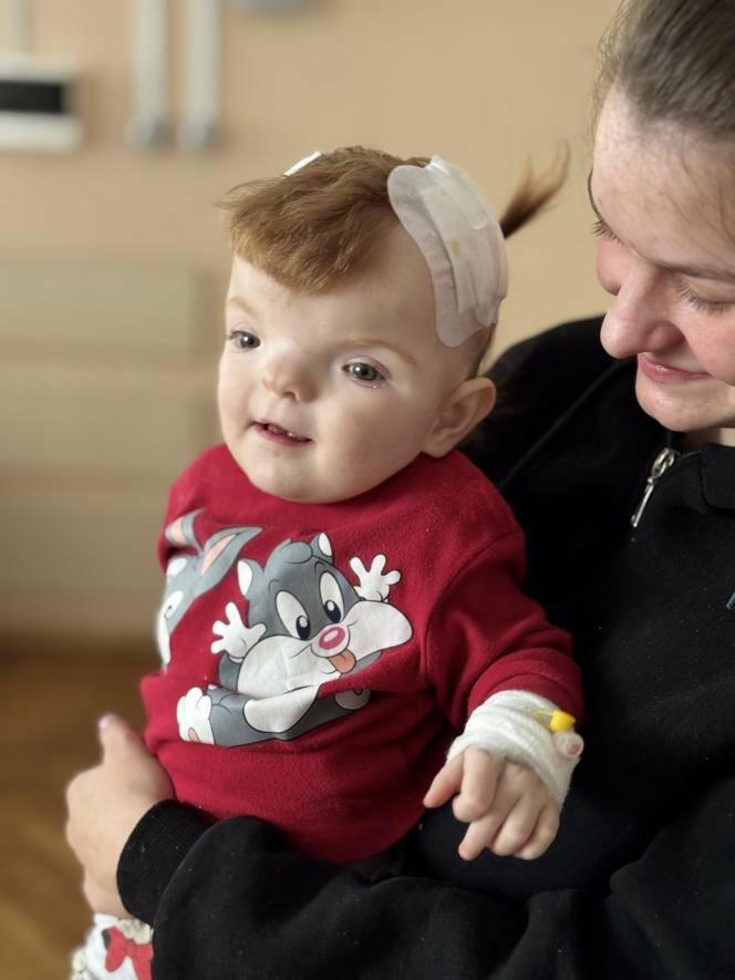Вперше у Львові: нейрохірурги встановили маленькій Емілії дистрактори для корекції черепа