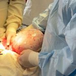 У Самборі лікарі видалили жінці кісту яєчника, що сягала розмірів баскетбольного м’яча