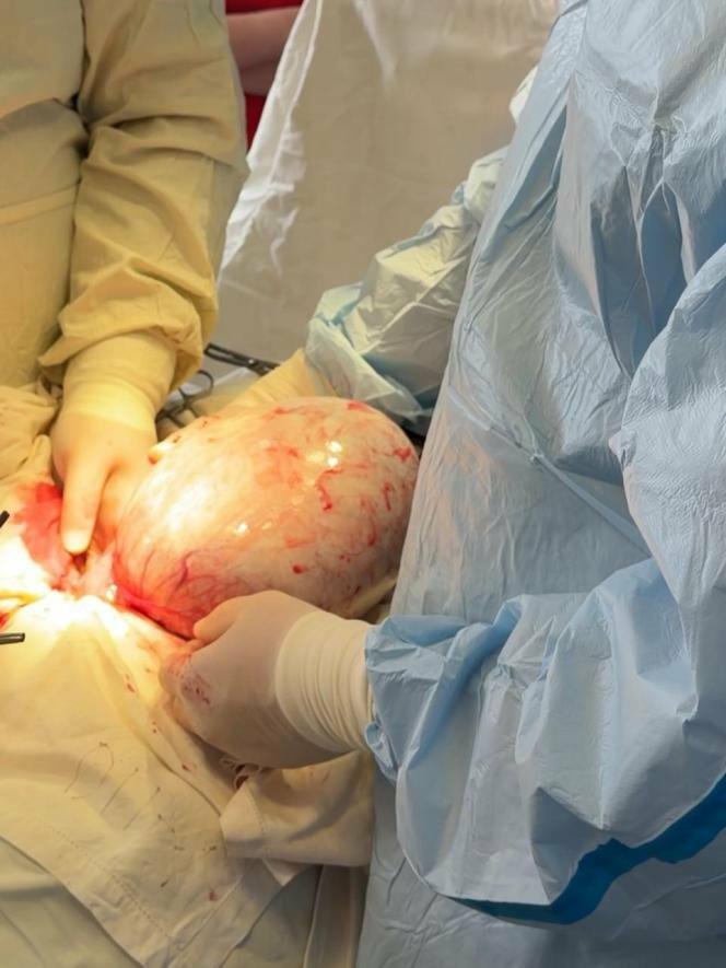 У Самборі лікарі видалили жінці кісту яєчника, що сягала розмірів баскетбольного м’яча