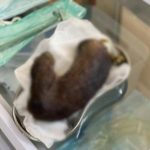 У Львові лікарі видалили зі шлунка дитини 35-сантиметровий клубок волосся при синдромі Рапунцель