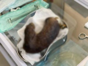 У Львові лікарі видалили зі шлунка дитини 35-сантиметровий клубок волосся при синдромі Рапунцель