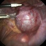 Хірурги на Львівщині видалили 16‑річній дівчині кісту яєчника розміром із грейпфрут