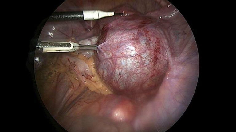 Хірурги на Львівщині видалили 16‑річній дівчині кісту яєчника розміром із грейпфрут